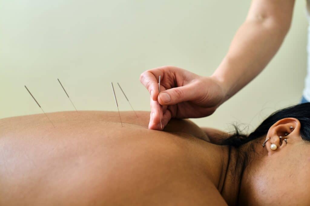 About Acupuncture