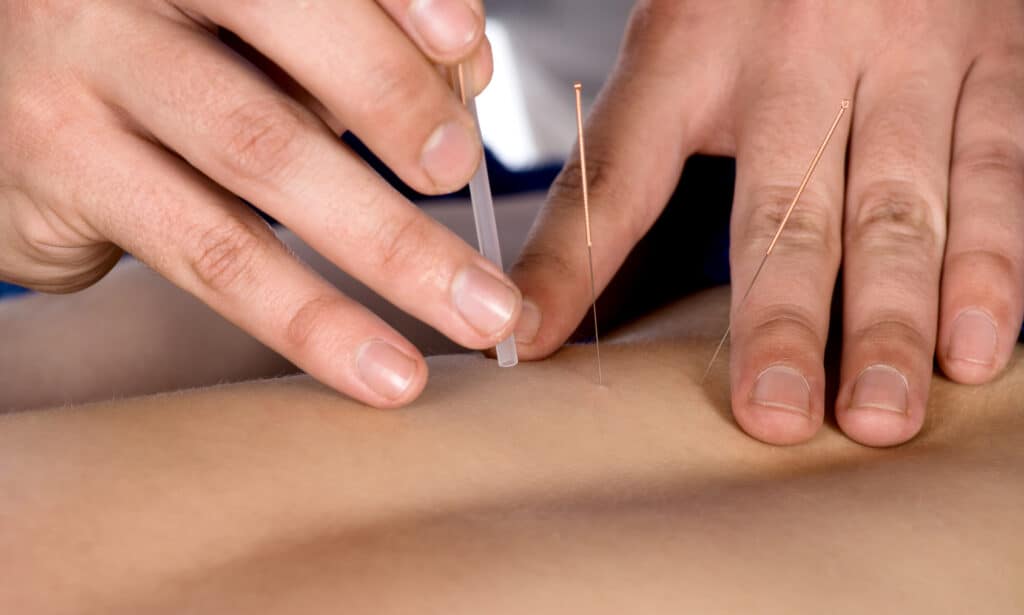 Enhancing Healing with Integrative Dry Needling
