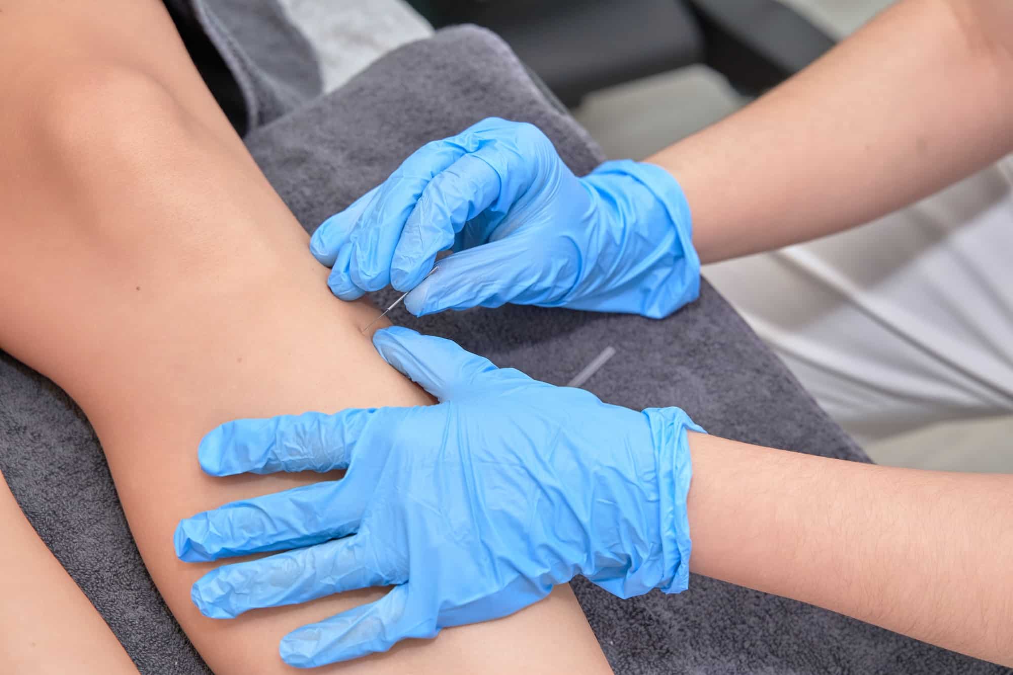 Close-up of physiotherapist performing dry needling treatment on leg.