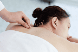 comfortable woman having acupuncture
