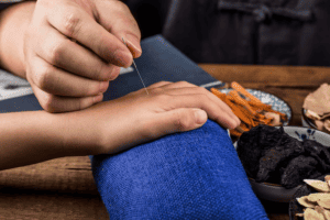 Acupuncture the hand