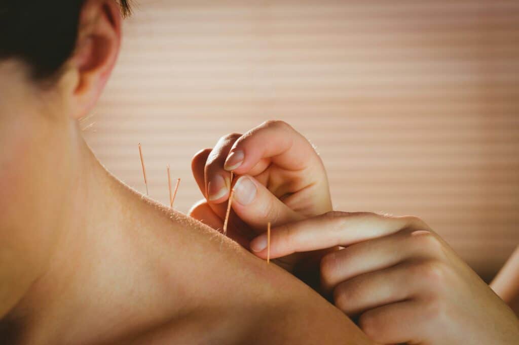 Acupuncture: Boosting Your Immune System