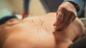 Acupuncture