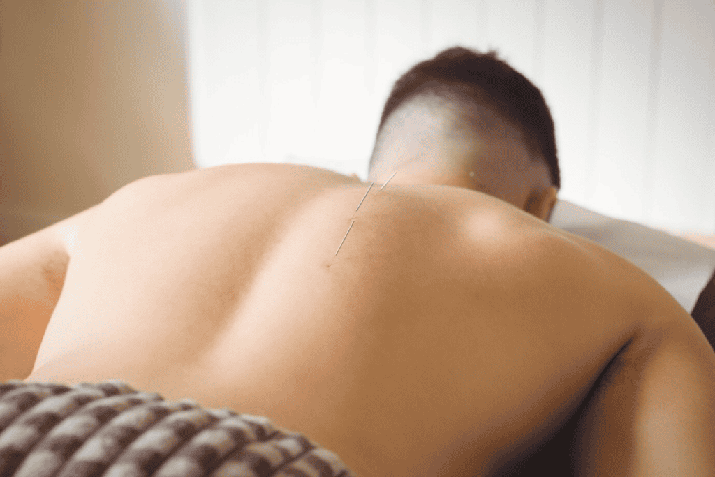 Acupuncture