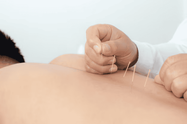 Acupuncture