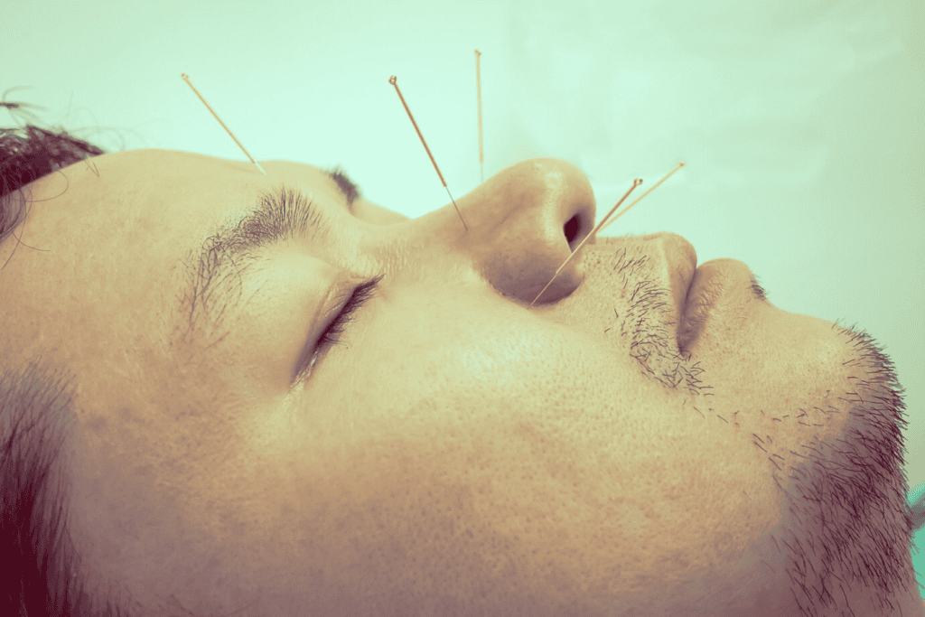 Acupuncture