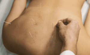 Acupuncture