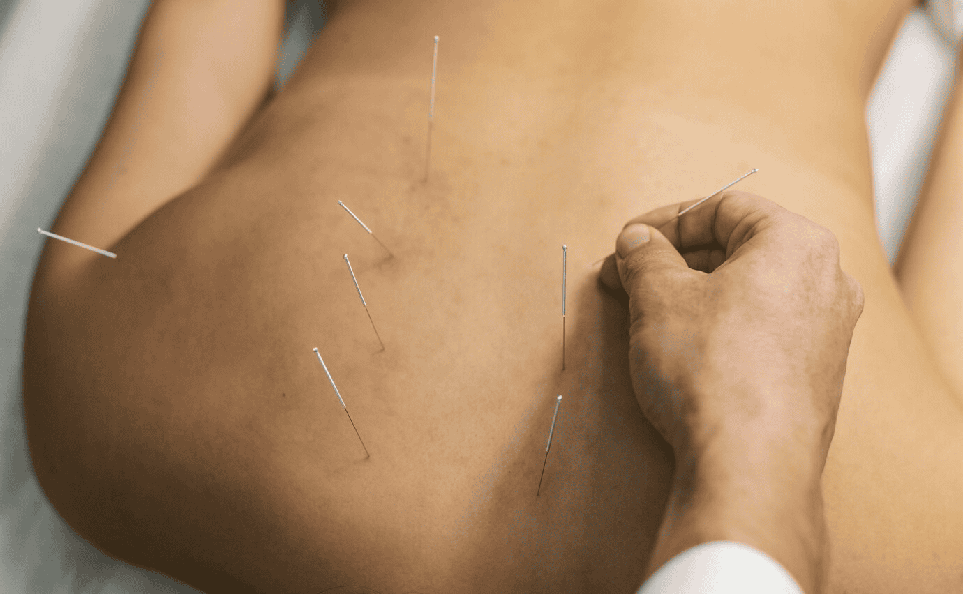 Acupuncture