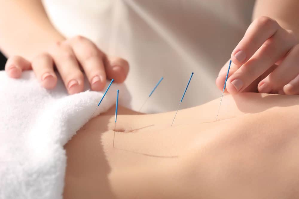 Acupuncture Poway