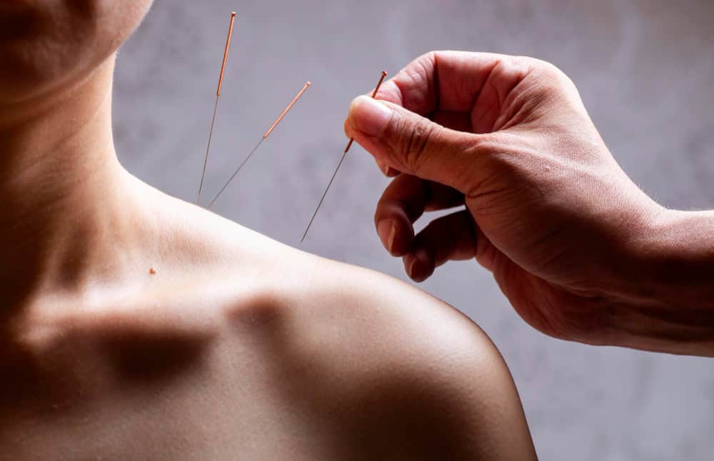 Acupuncture Encinitas