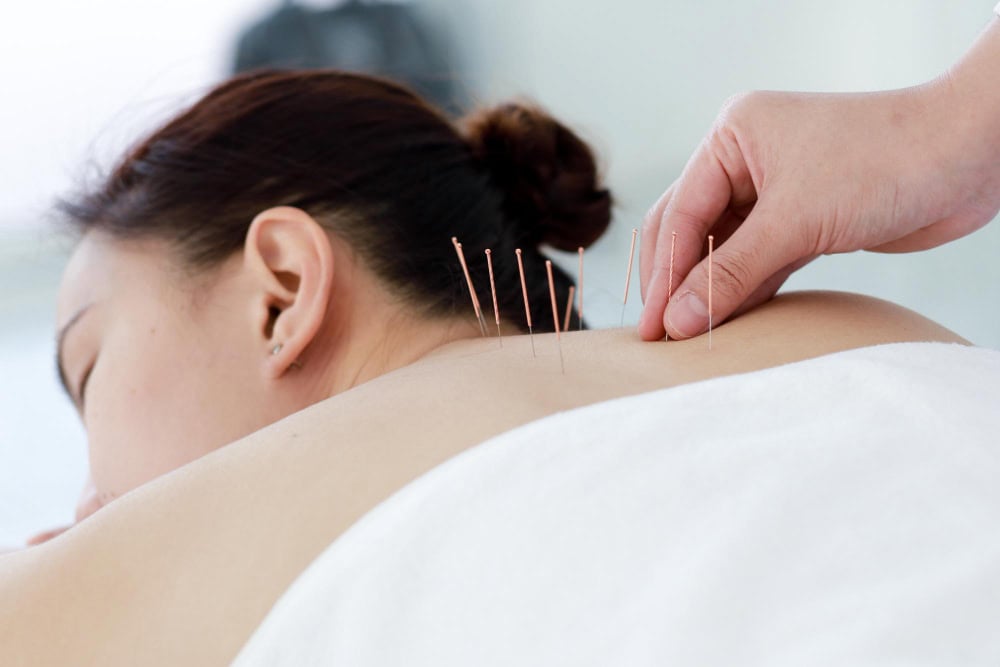 Acupuncture Poway