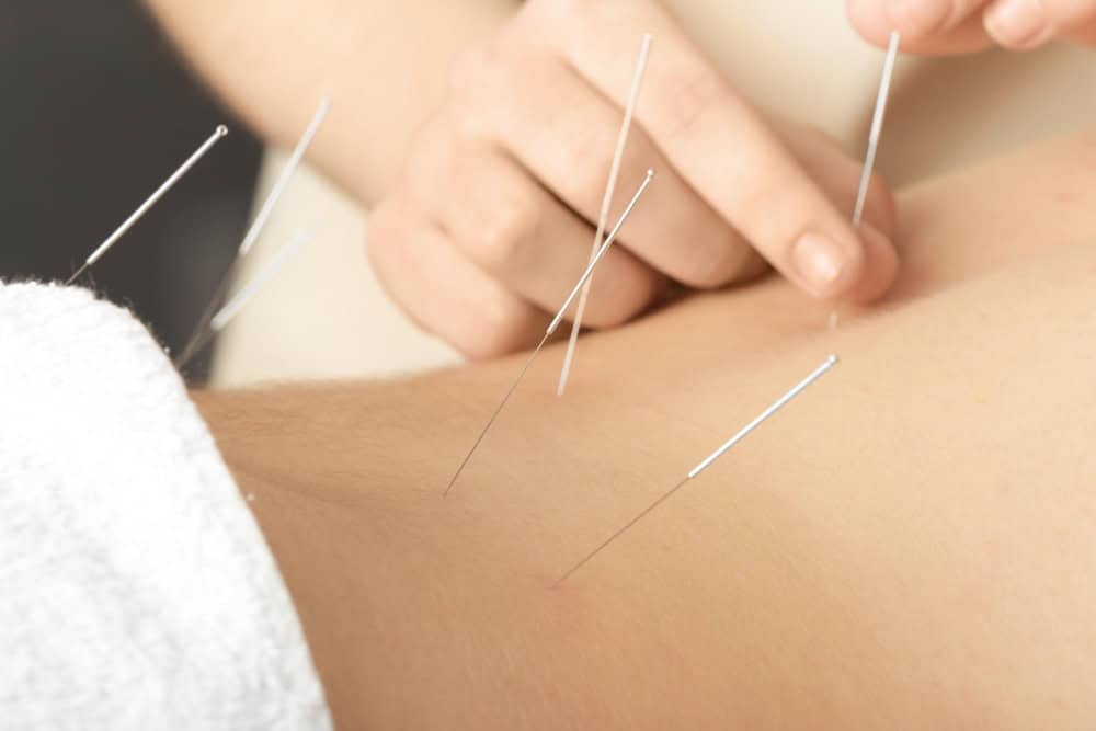 Acupuncture Encinitas