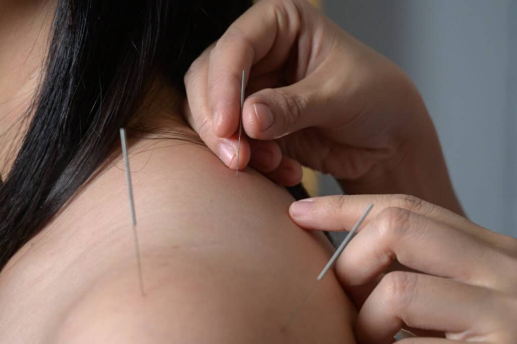 Acupuncture Encinitas