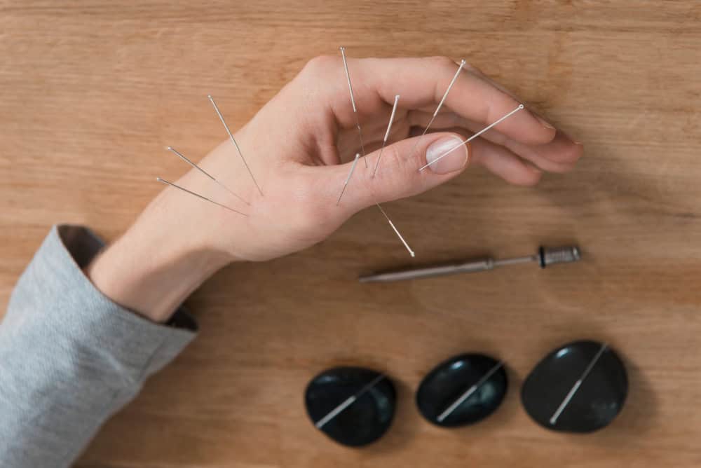 Acupuncture Poway