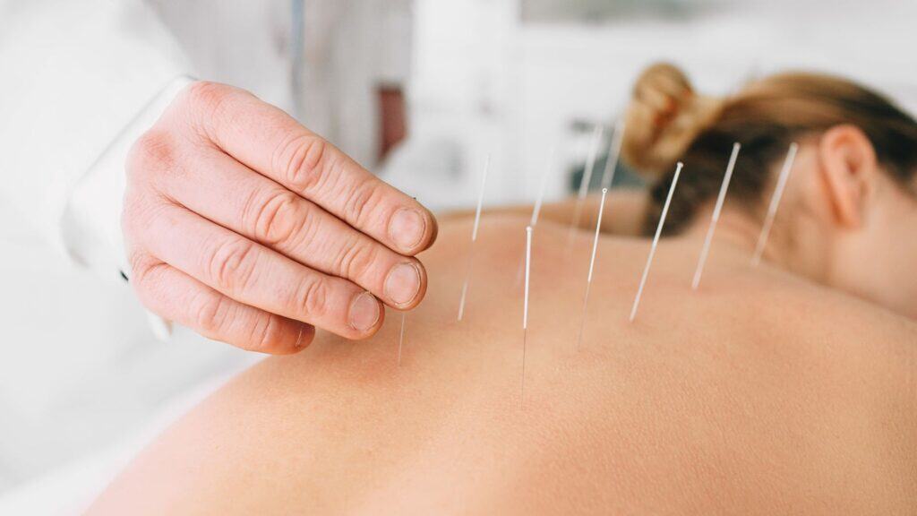 Acupuncture Poway
