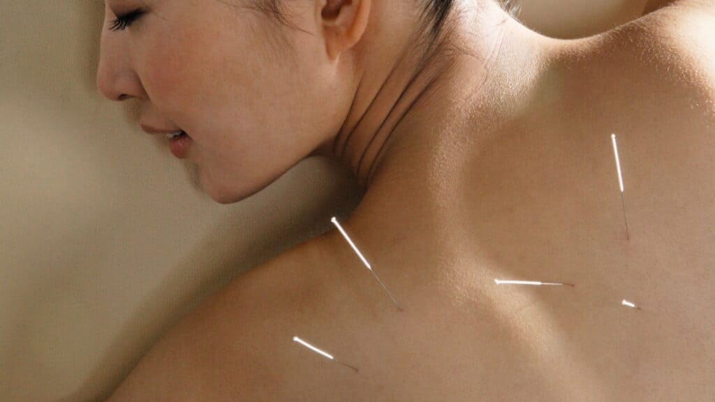 Acupuncture Encinitas
