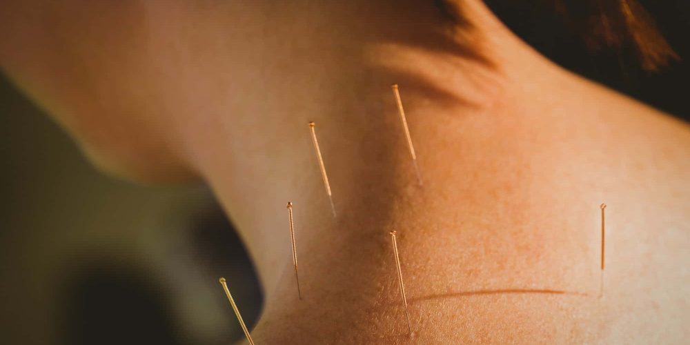About Acupuncture
